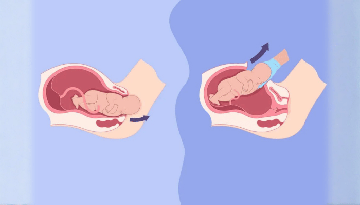 Normal Delivery Vs C-Section – Which one is the best for you? 1