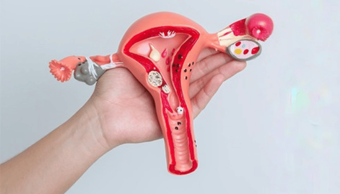 What size of Uterus Fibroids is dangerous? 1