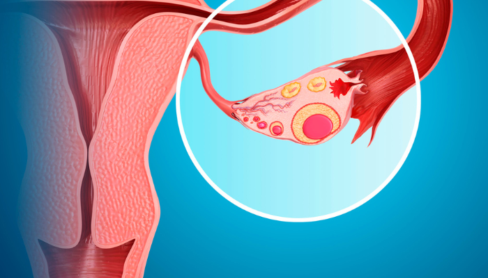 What is Ovarian Cysts