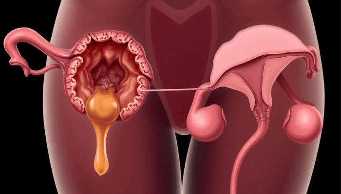 Ovarian Cyst Ruptures