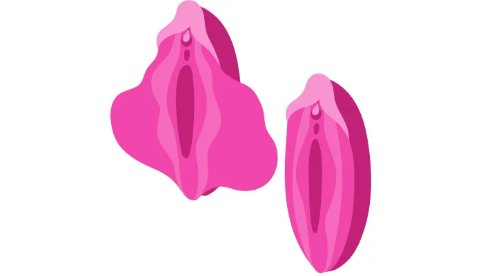 What is the recovery process like after Vaginoplasty? 2