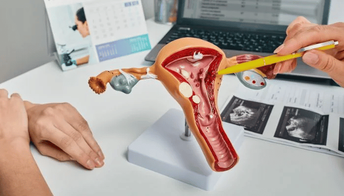 How to deal with a bulky uterus with multiple fibroids? 2 fibroid