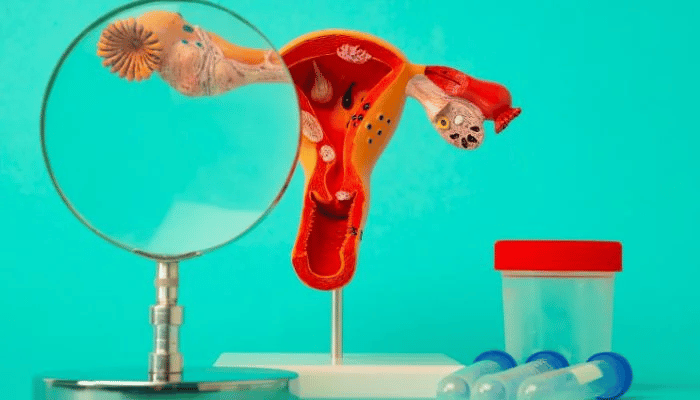 Ovarian Cancer