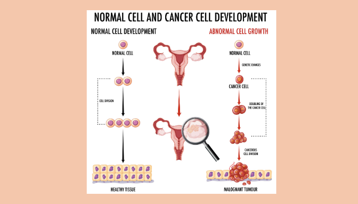 Ovarian Cancer in Dubai