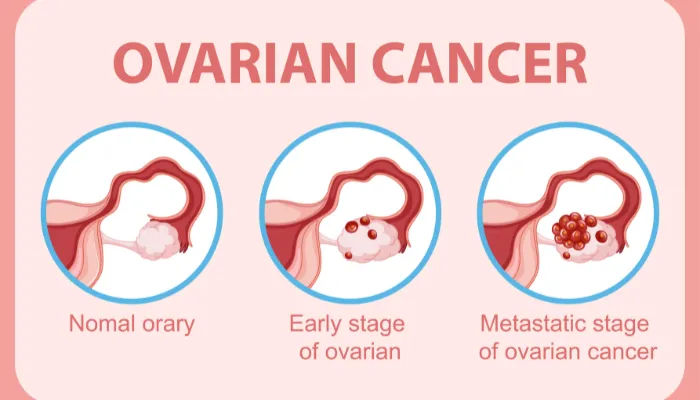 ovarian cancer blog img 5